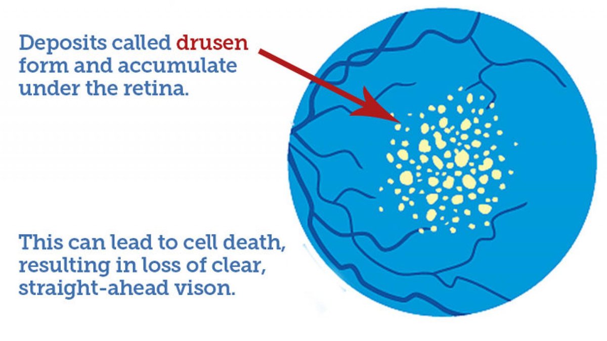 Illustration of drusen accumulating under the retina. Drusen are a defining feature of macular degeneration.