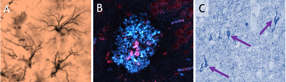 Figure 1. A= Activated inflammatory cells. B = Plaque in AD brain consisting of the protein amyloid-beta (blue), a toxic protein contributing to pathology. C = Tangles (arrows) in DS and AD in neurons resemble “flames” that will kill the nerve cell.