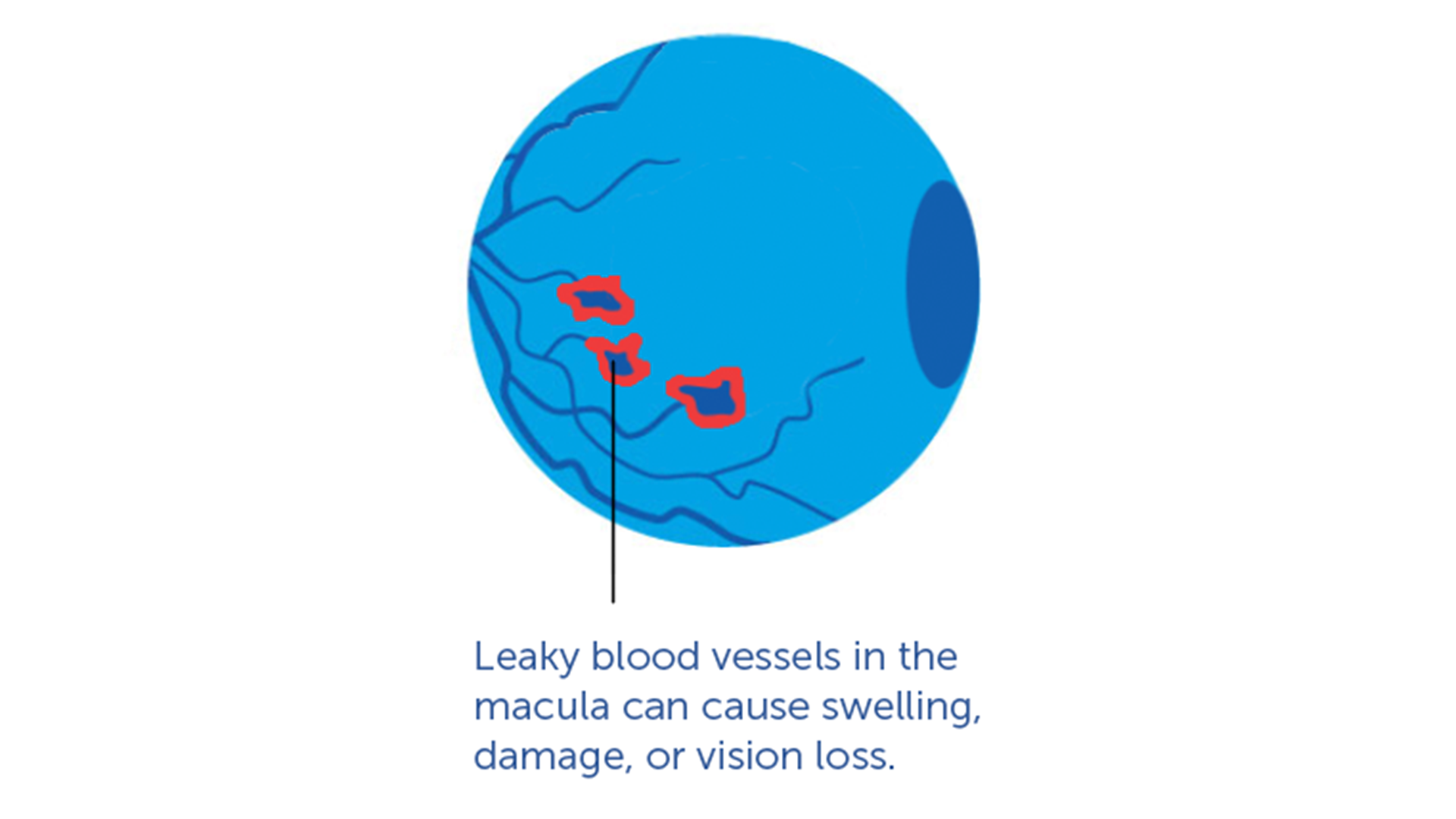 a graphic illustration of Advanced Stage (wet amd)