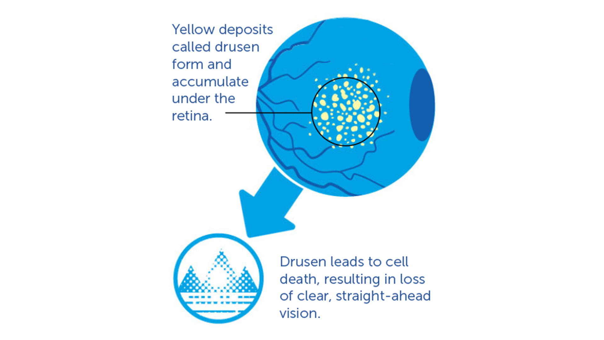 a graphic illustration of Early and Intermediate Stage (Dry AMD)