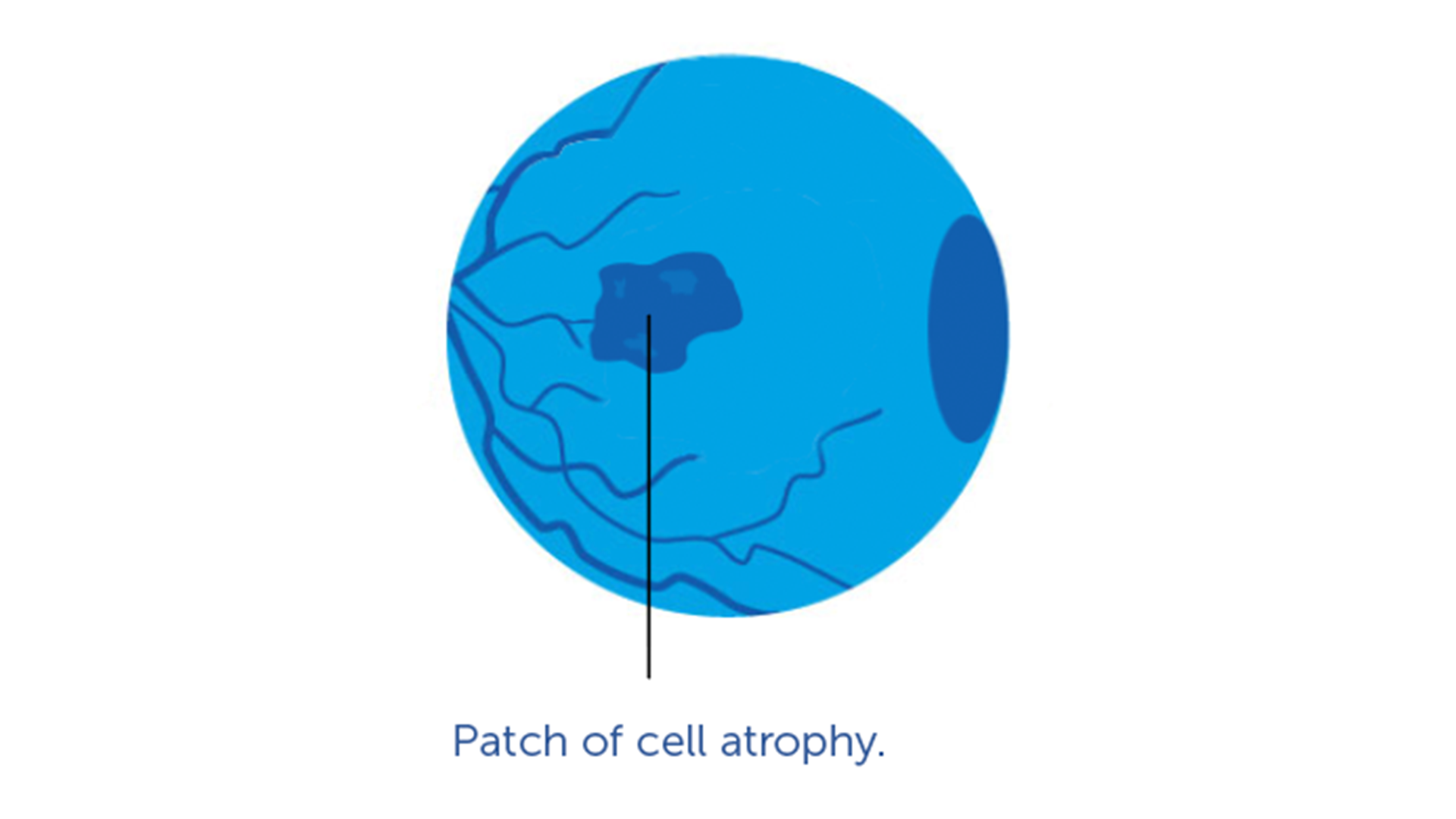 a graphic illustration of geographic atrophy (Dry AMD)