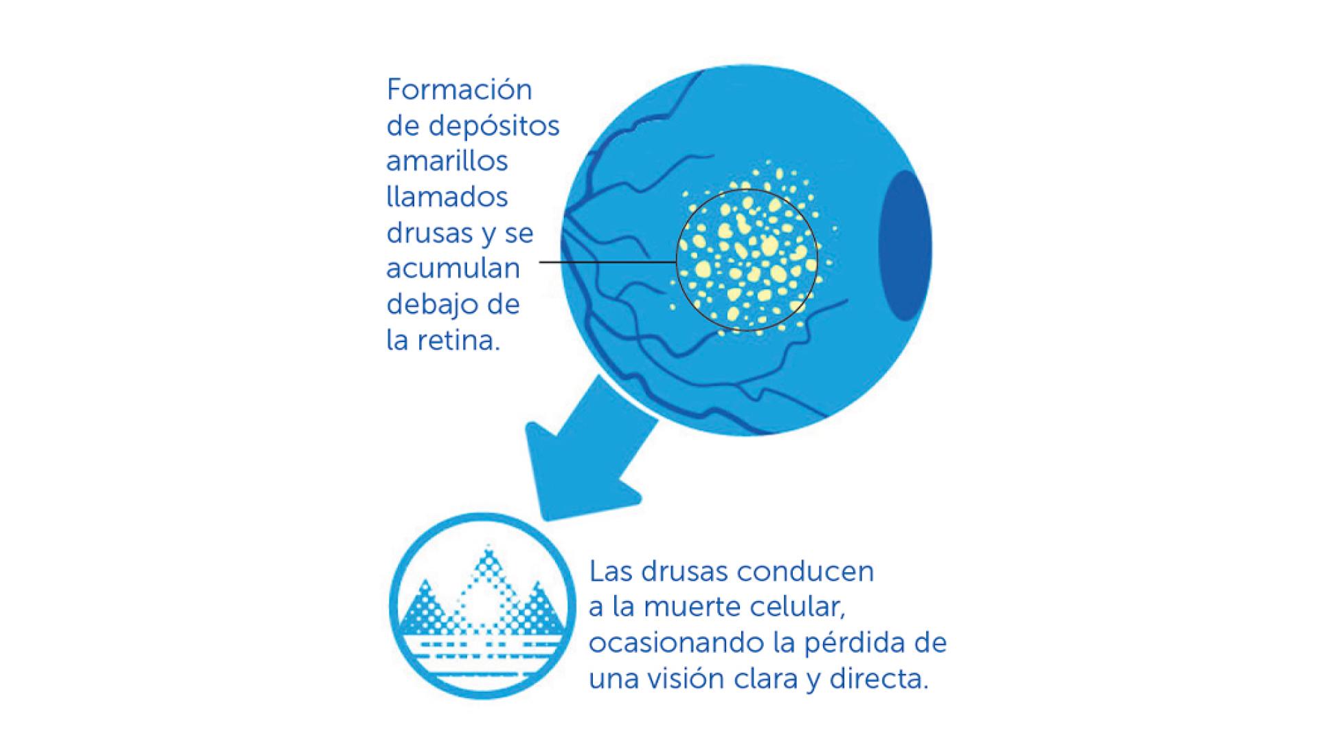 Formación de depósitos amarillos llamados drusas y se acumulan debajo de la retina.