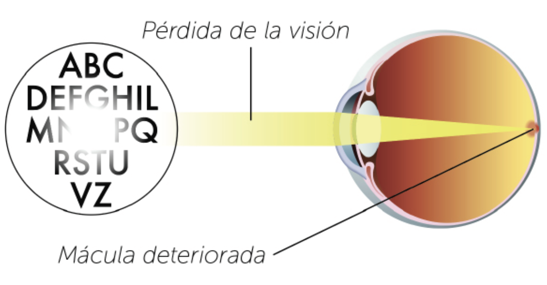 Mácula deteriorada diagram.