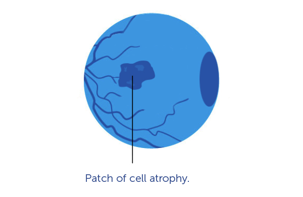 An illustration of an eye with a patch of cell atrophy.