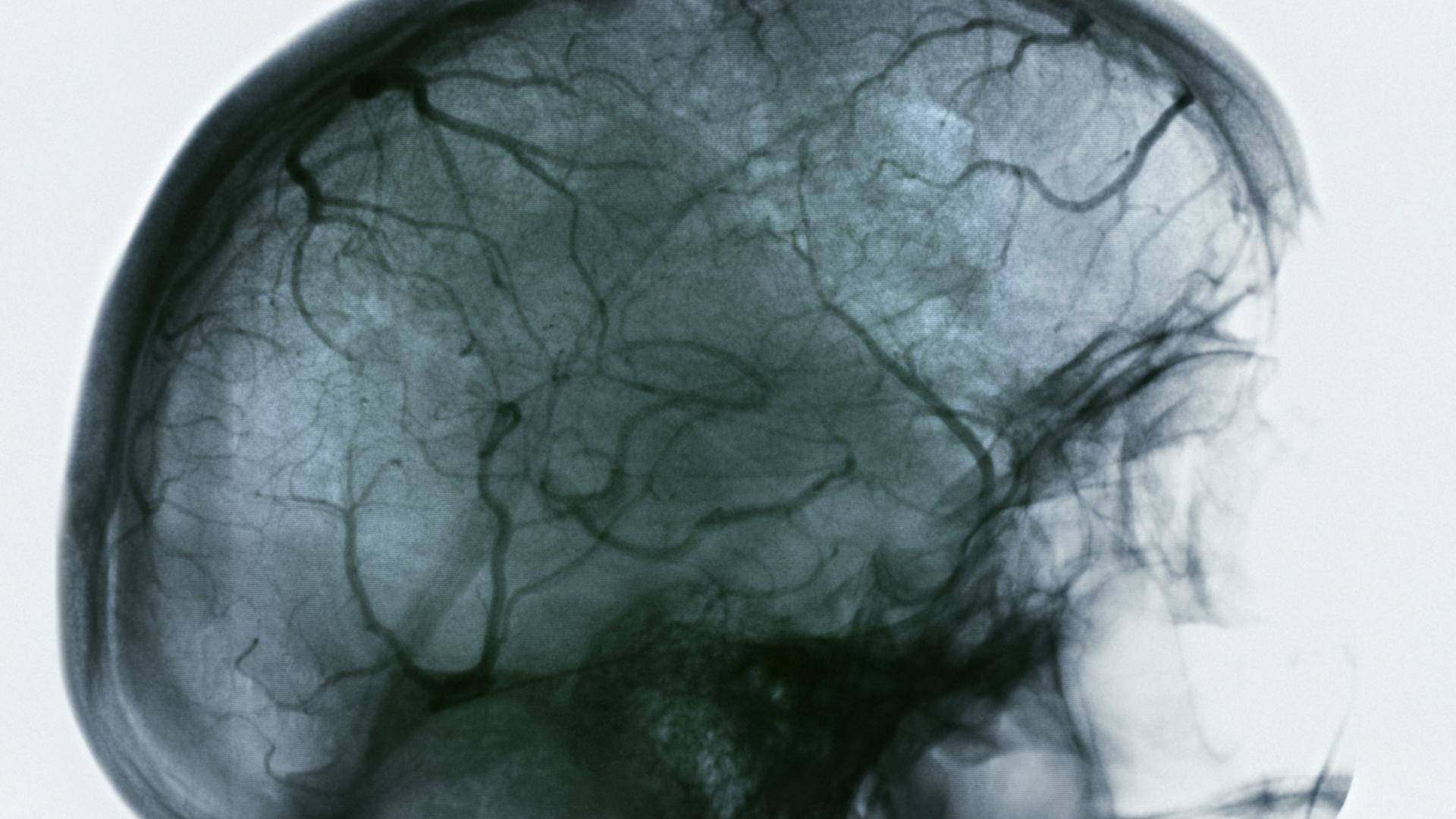 Arteriogram of the brain.