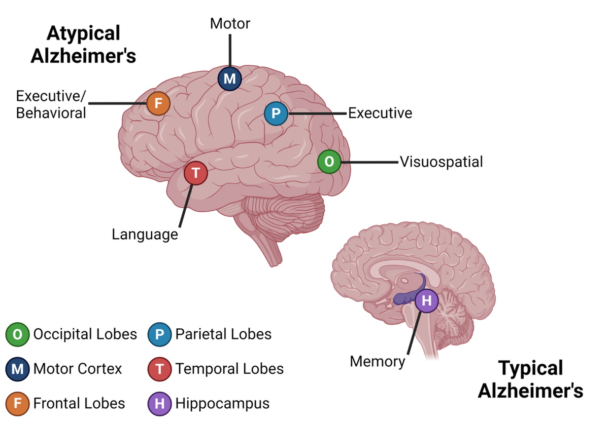 Diagram comparing brain regions affected by typical and atypical Alzheimer's disease. The typical form affects the hippocampus (memory), while the atypical form affects areas like the motor cortex, occipital, parietal, frontal, and temporal lobes, impacting functions such as language, visuospatial skills, and executive control.