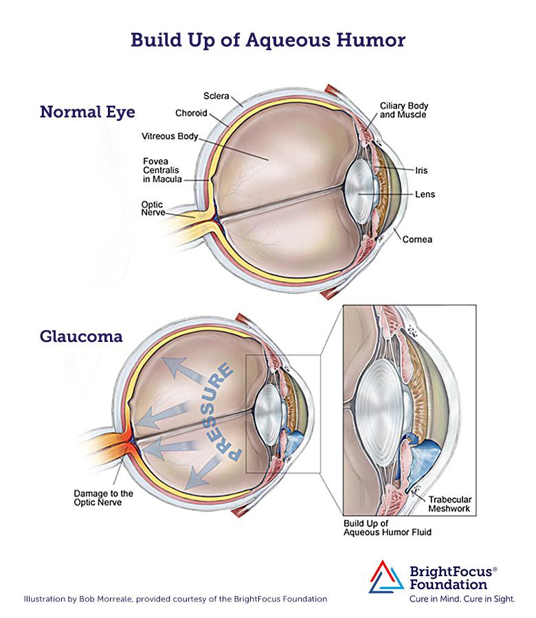 a diagram explaining how the buildup of aqueous humors causes eye pressure to increase