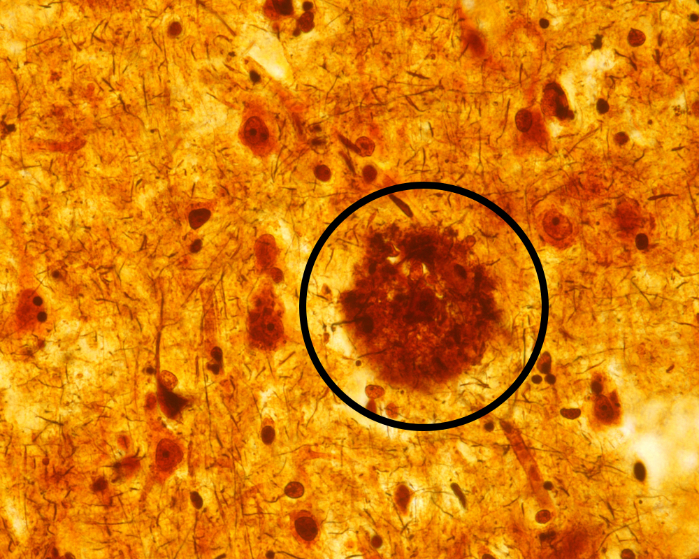 A microscope image of an amyloid plaque in human brain tissue.