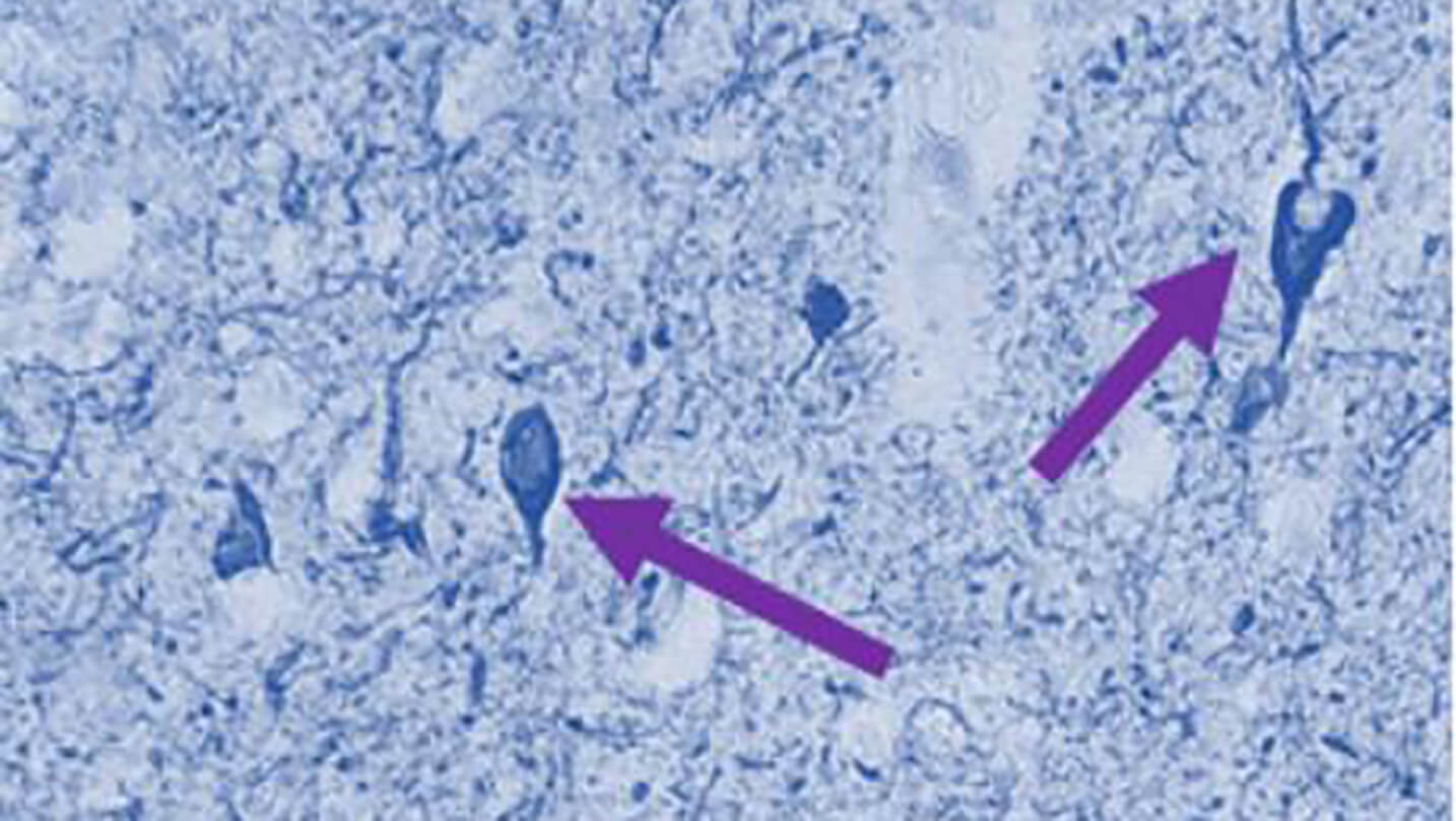 Tau tangles accumulating in neurons.