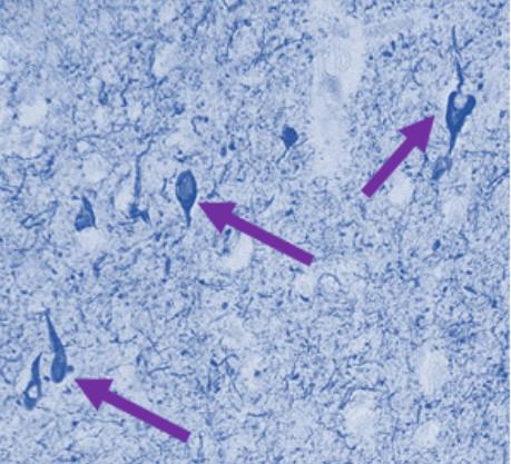 Tau tangles accumulating in neurons.