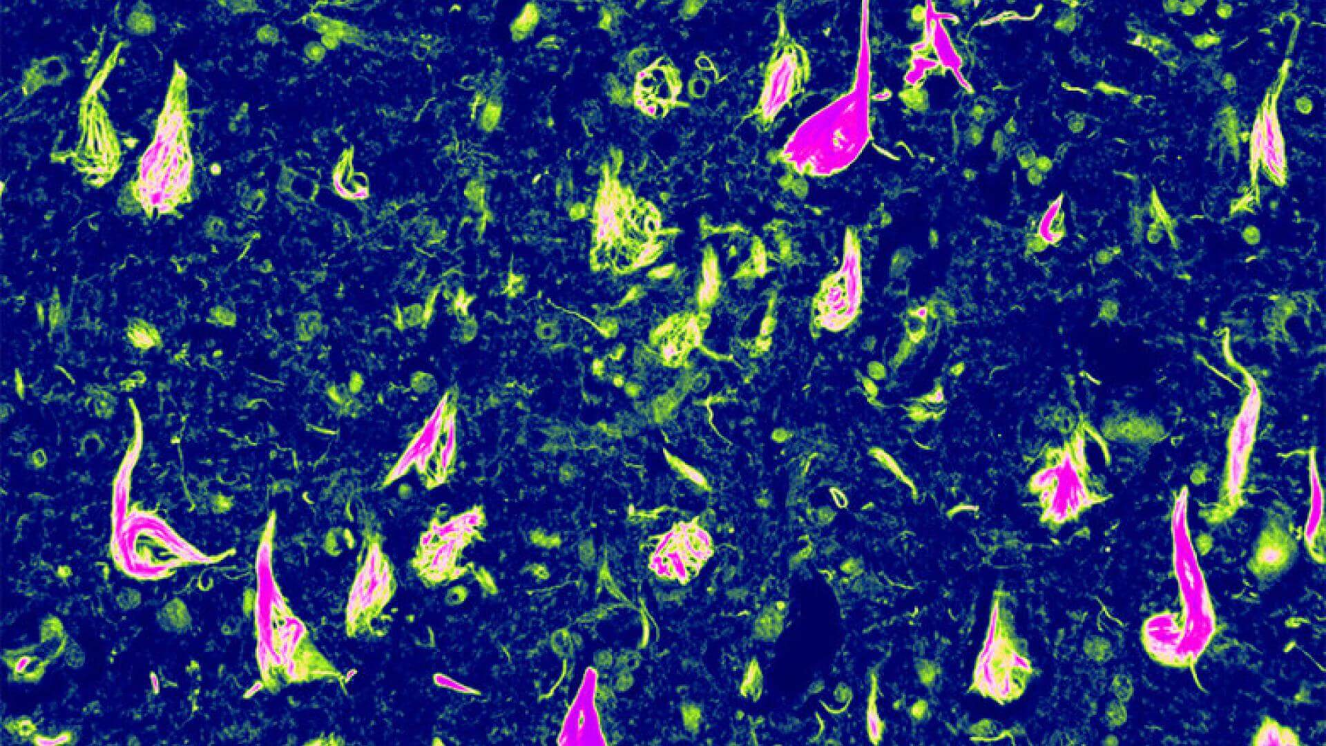 Abnormal neurofibrillary tangles (NFTs).