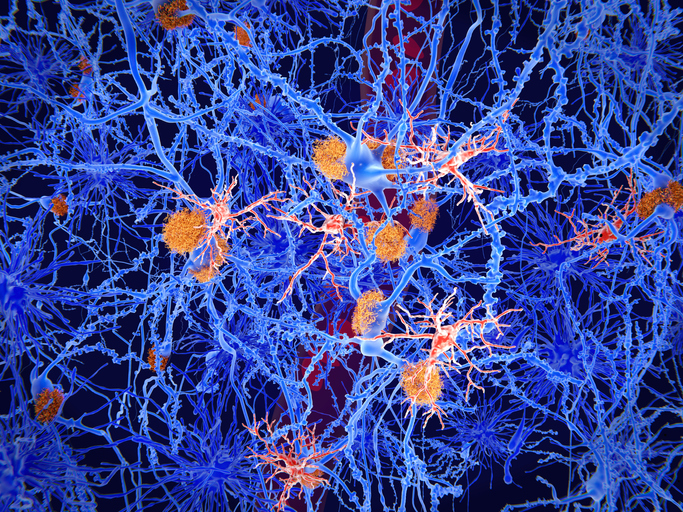 Amyloid plaques (orange) deposited in between brain cells responsible for communication (blue) and immune response (red).