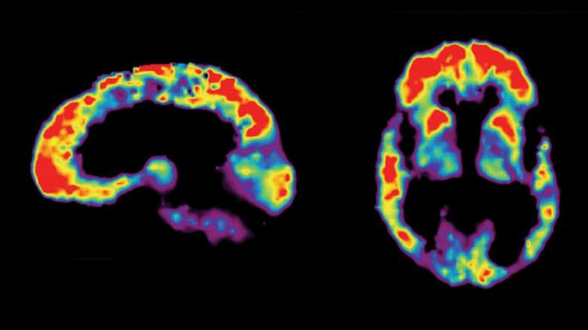 "Brain scan images showing amyloid plaque buildup, with red areas indicating higher concentrations.