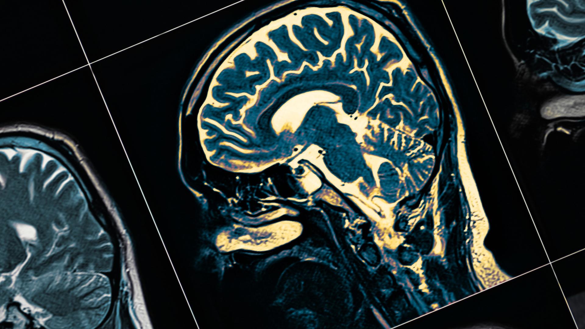 Close-up of a medical brain scan with a sagittal view, displaying detailed neural structures and highlighted regions. The black background and intersecting grid lines emphasize the clinical and diagnostic nature of the imaging.