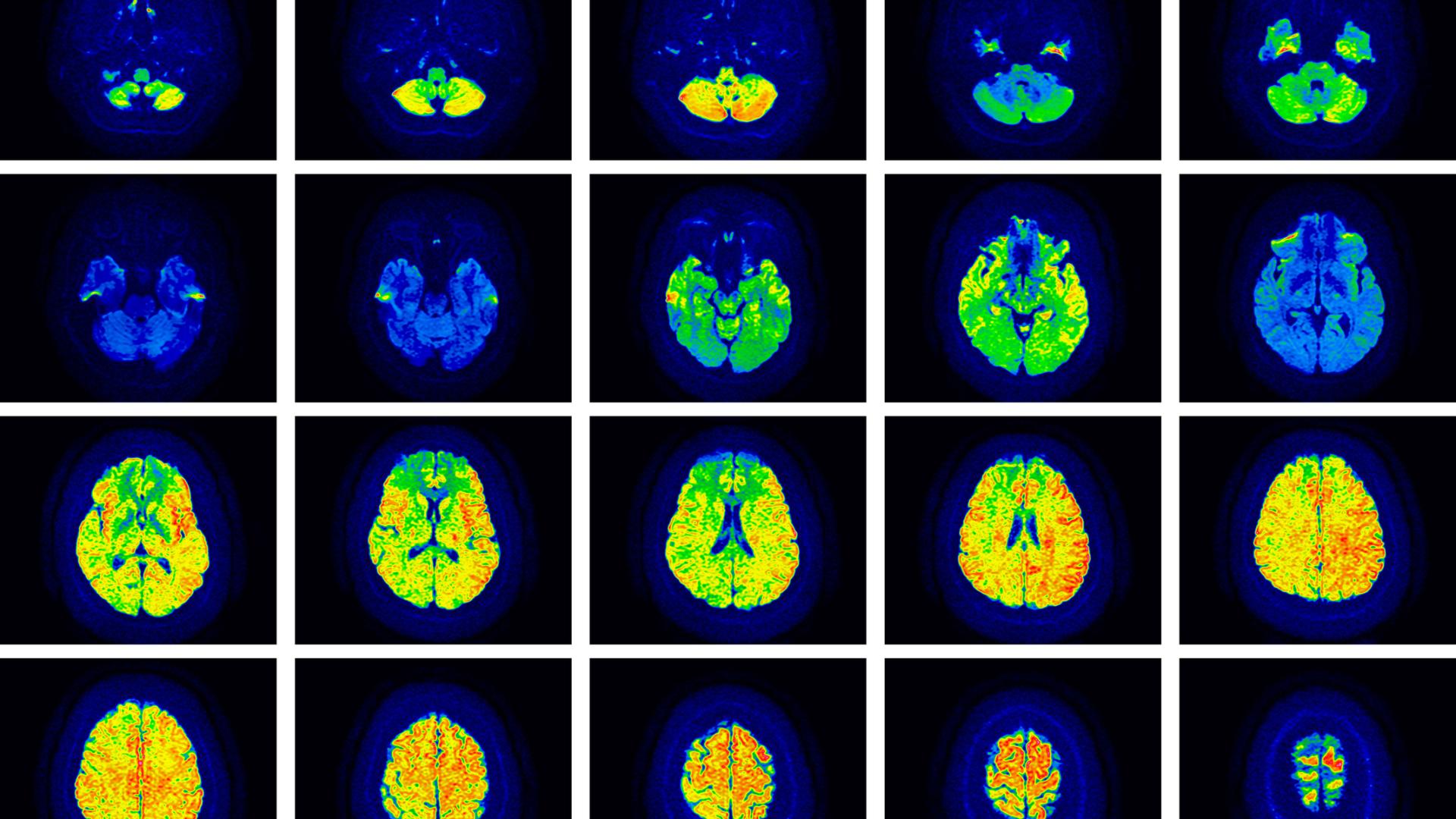 Colorful image of a brain scan.