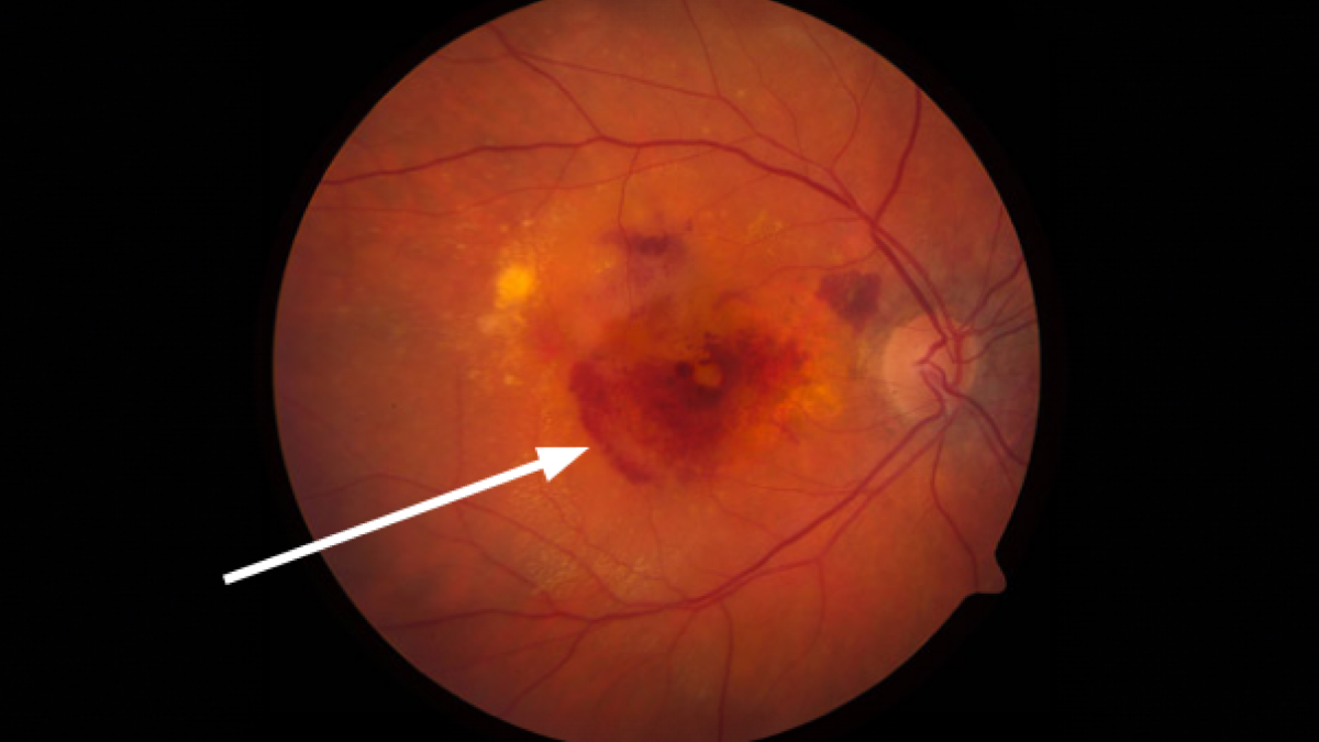 Close-up image of a human retina displaying signs of diabetic retinopathy, with an arrow pointing to an area of hemorrhage and abnormal vessels.