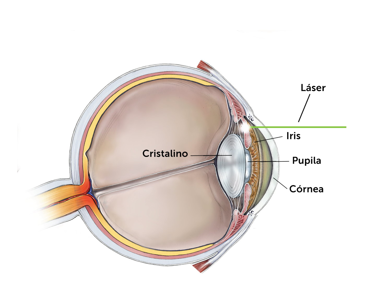 a diagram explaining how laser eye surgery works