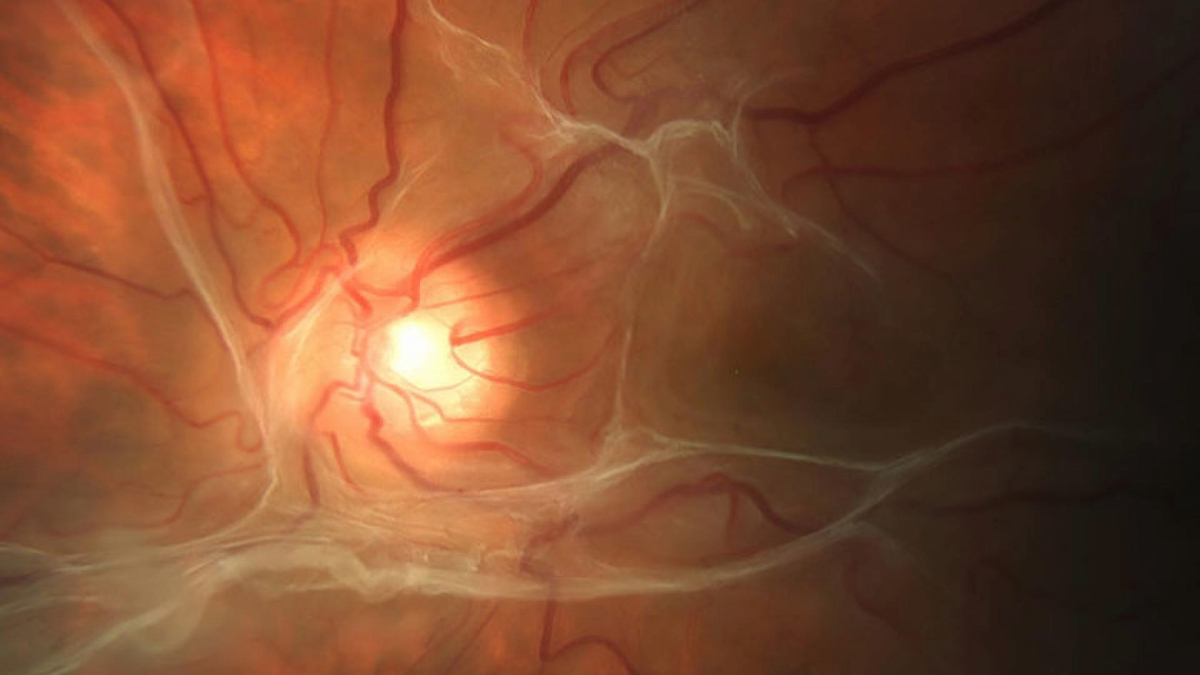 Close-up image of a human retina displaying intricate blood vessels around the optic disc.