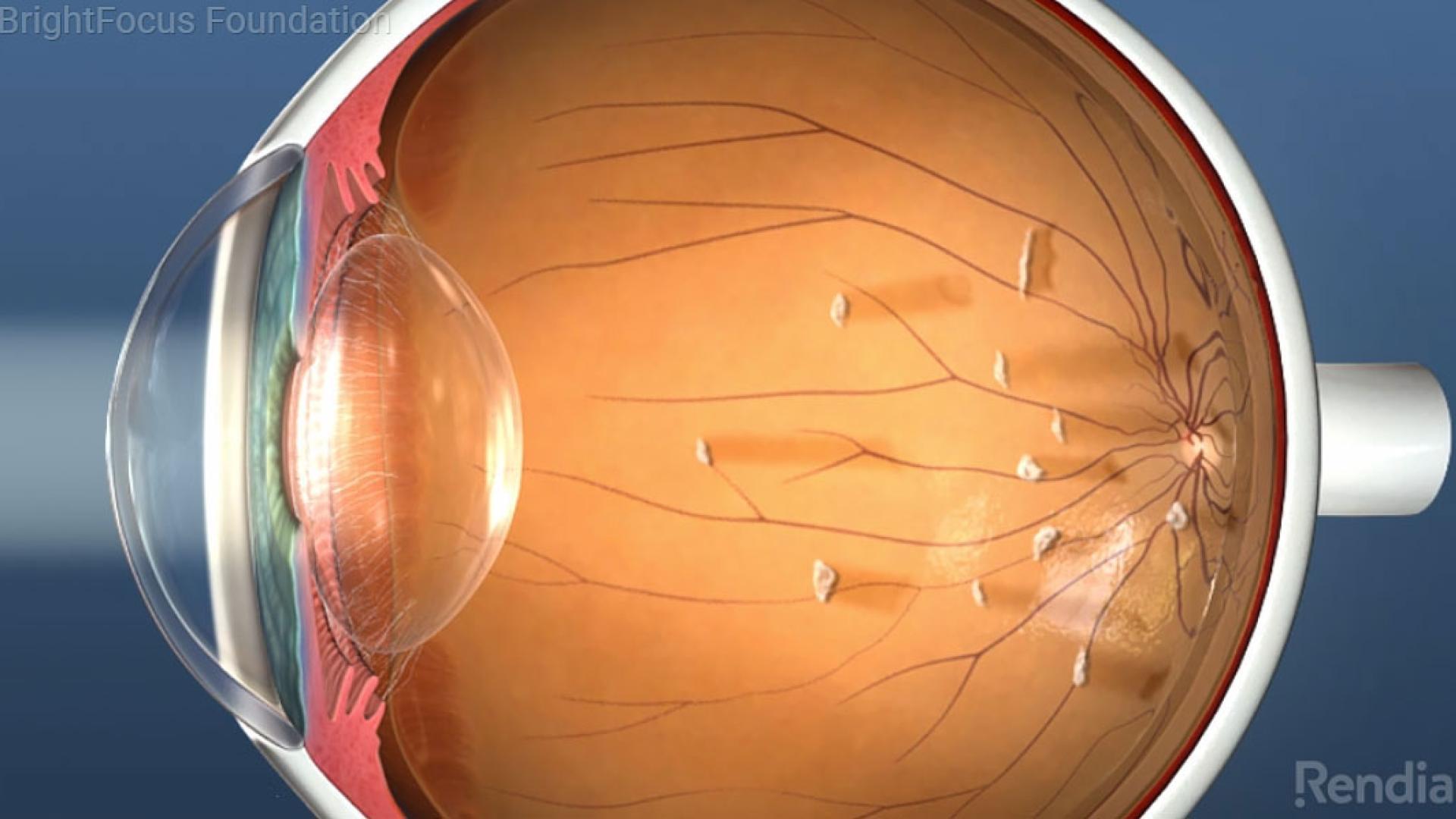 Illustration showing a cross-section of the eye with floaters.