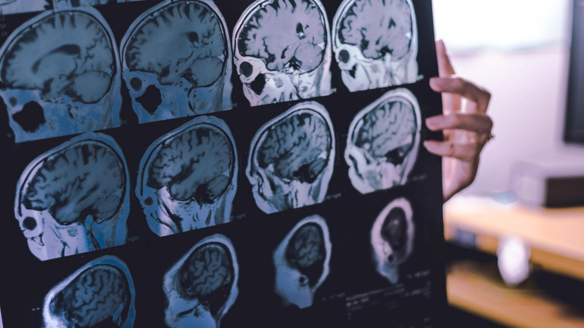 A person is holding up an X-ray film displaying multiple images of a human brain MRI scan.