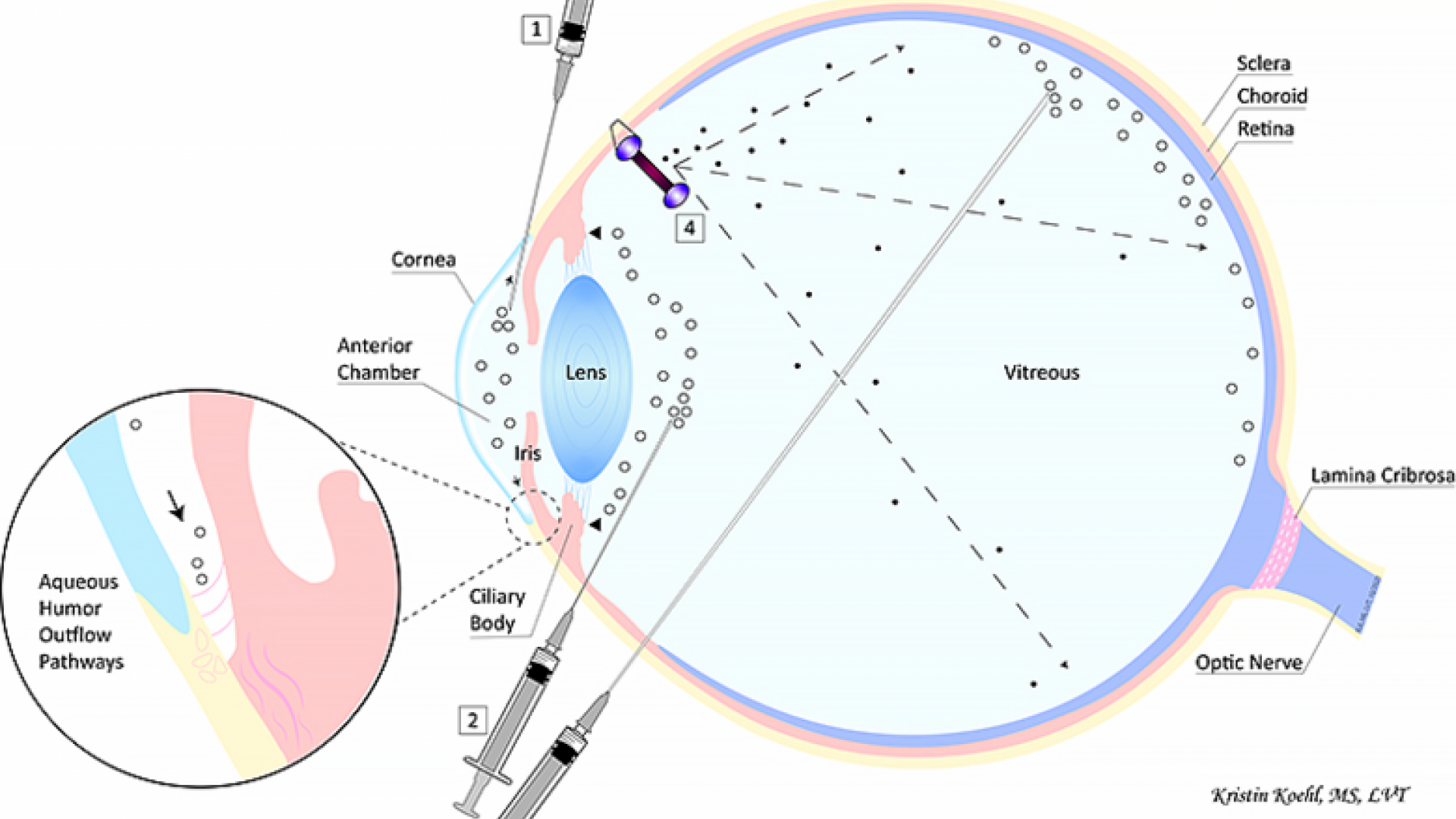 a cross-section diagram of an eye illustrating how gene therapy treatments work for glaucoma patients