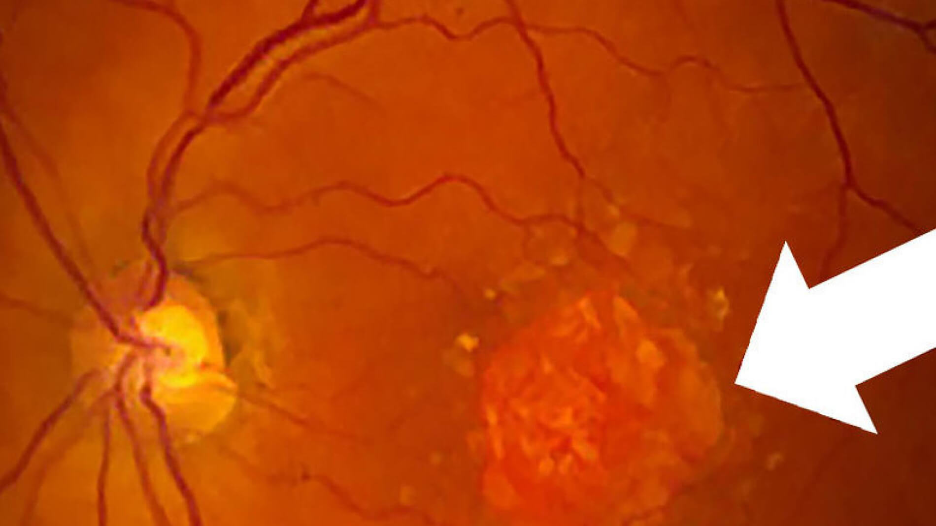 An image of the retina showing a region of geographic atrophy (advanced dry macular degeneration),