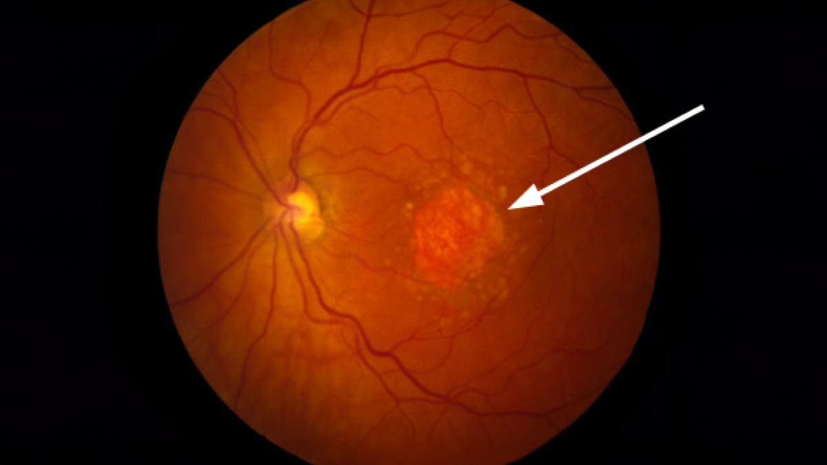 Image of a retina, with an image pointing to a bright area of geographic atrophy.