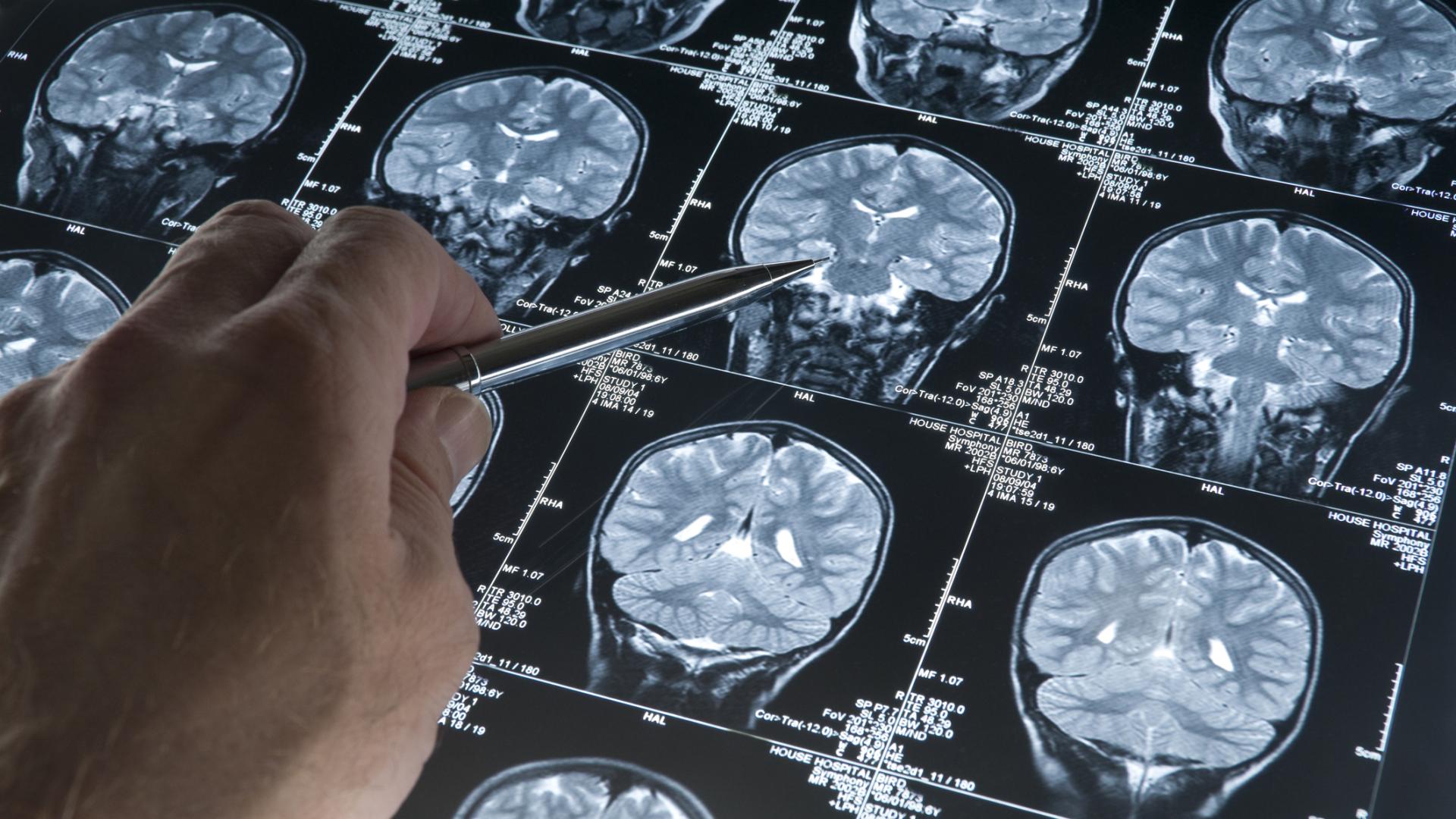 Hand holding a pen pointing at a series of brain scan images.