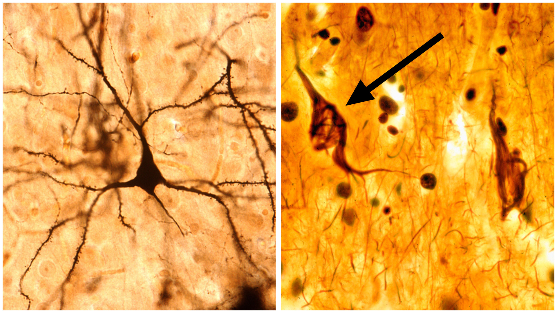 A microscope image of a healthy neuron (left) versus a neuron with neurofibrillary tau tangles (right).