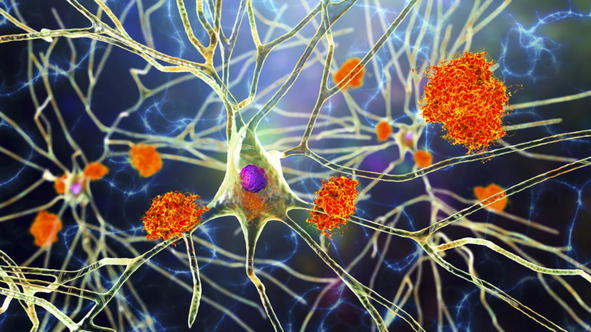 A brain cell called a neuron with tau tangles inside the cell body and amyloid plaques outside the cell.