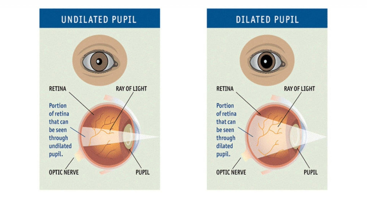 Comparative illustration showing an undilated pupil and a dilated pupil, each displaying labeled parts including the retina, ray of light, pupil, and optic nerve.