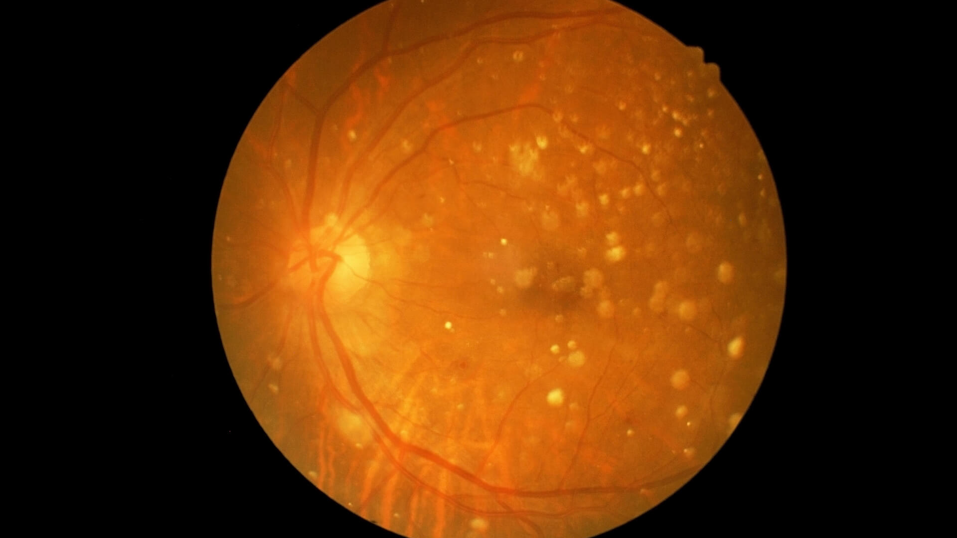 The macula with geographic atrophy present.