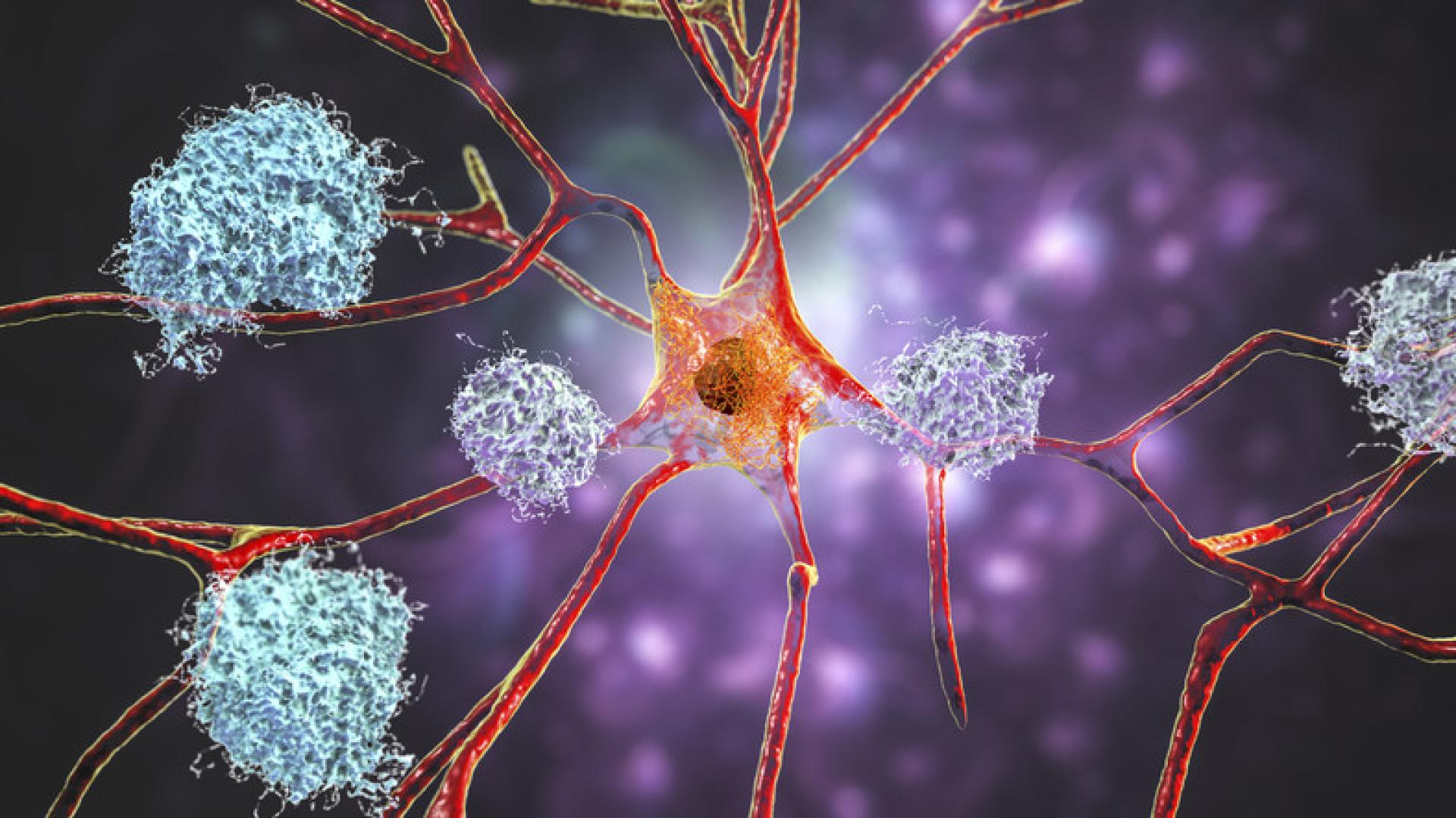 Nerve cells affected by Alzheimer's disease.