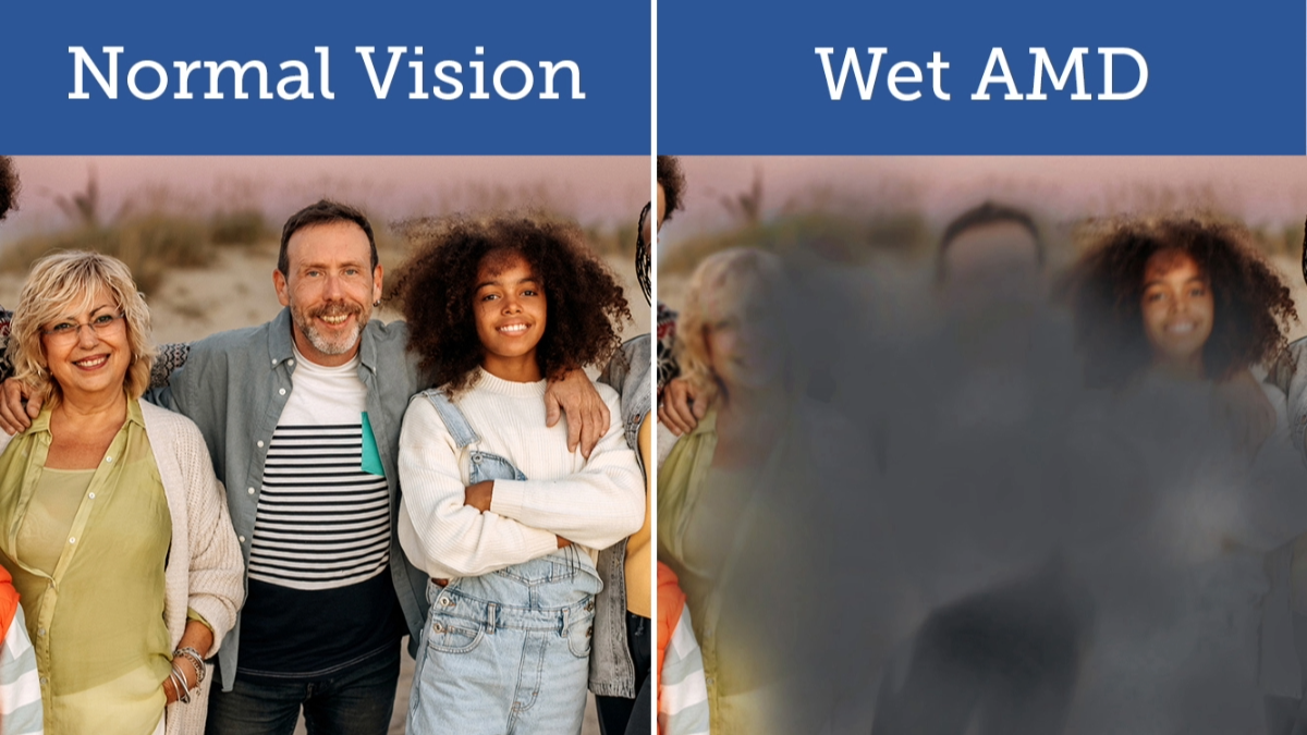 Image split into two panels titled 'Normal Vision' and 'Wet AMD.' The left panel shows three smiling people standing closely together on a sandy background, the right panel shows a blurred version of the same image to simulate the visual effect of Wet AMD.