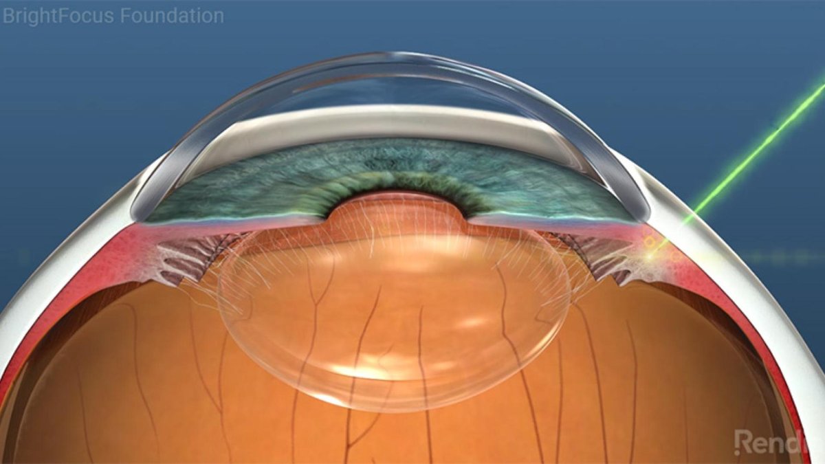 A medical illustration of an eye showing the laser treatment for cyclophotocoagulation, depicting the layers of the eye and where the laser is applied to relieve intraocular pressure.