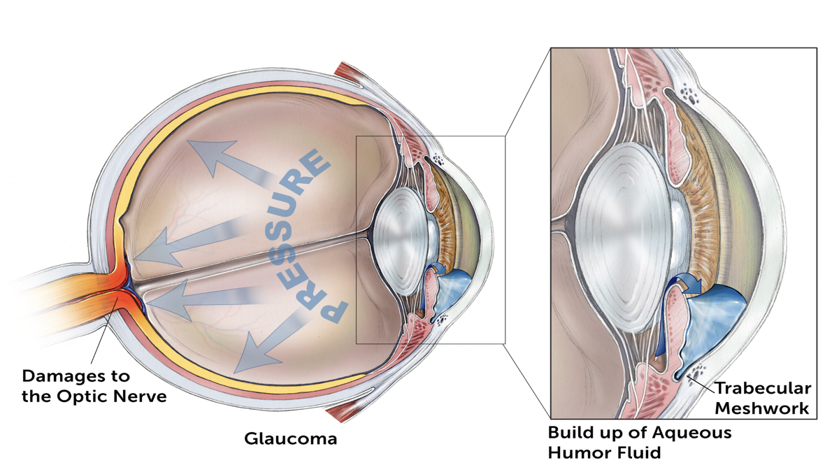 A cross-sectional illustration of an eye showing the build-up of aqueous humor fluid and the increased pressure on the optic nerve caused by glaucoma.