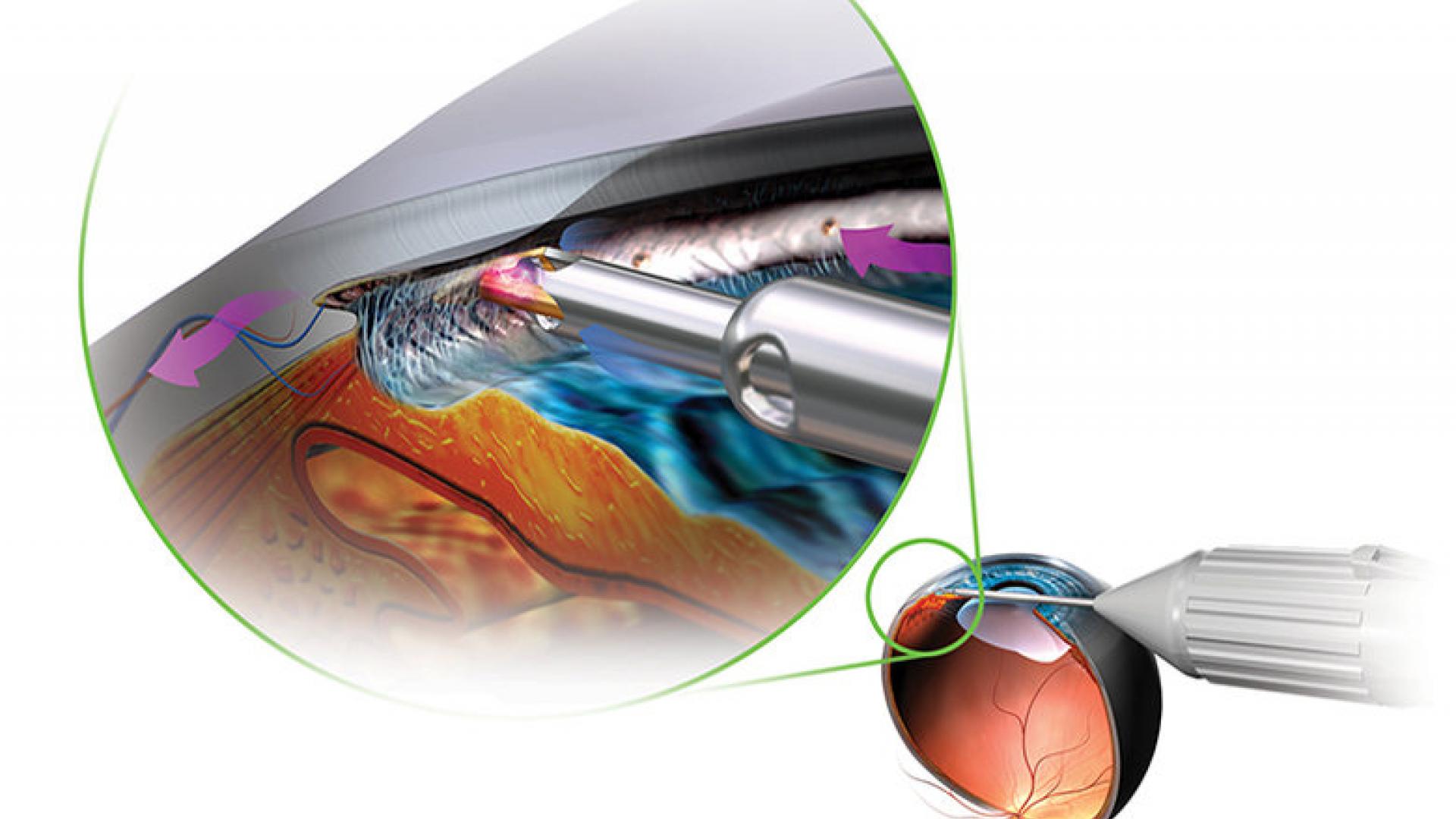 An illustration of the trabectome device in use.