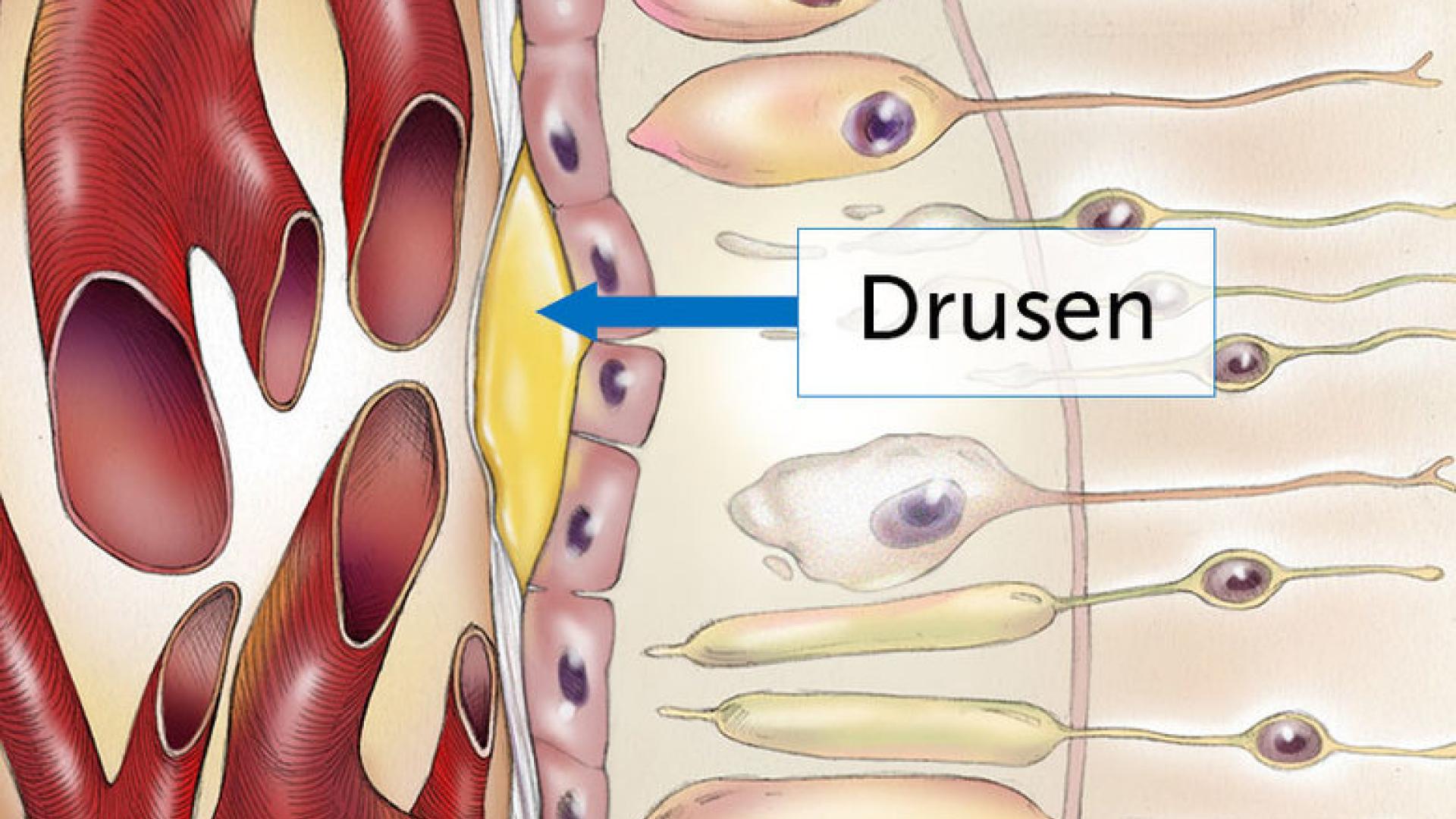 A medical graphic showing a drusen deposit in the retina.