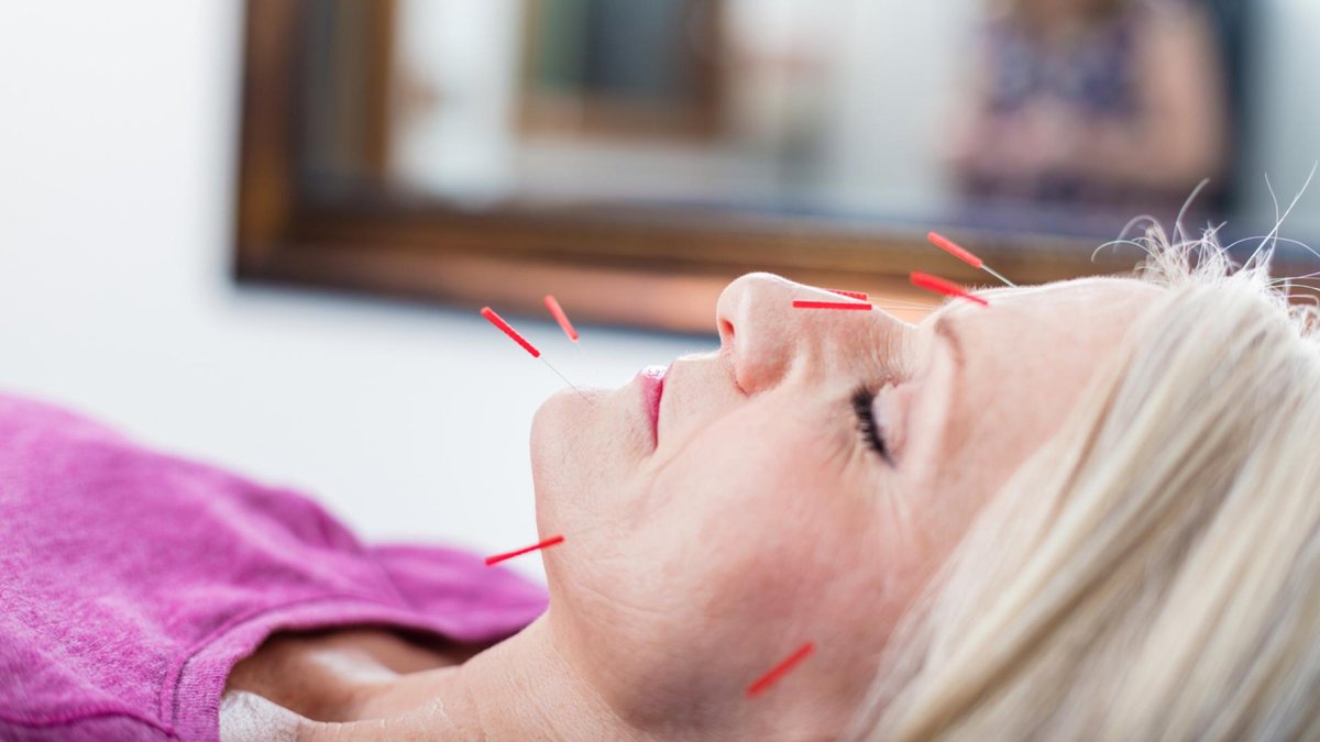 A woman receiving facial acupuncture treatment lies peacefully on a table, with red acupuncture needles inserted into her face.