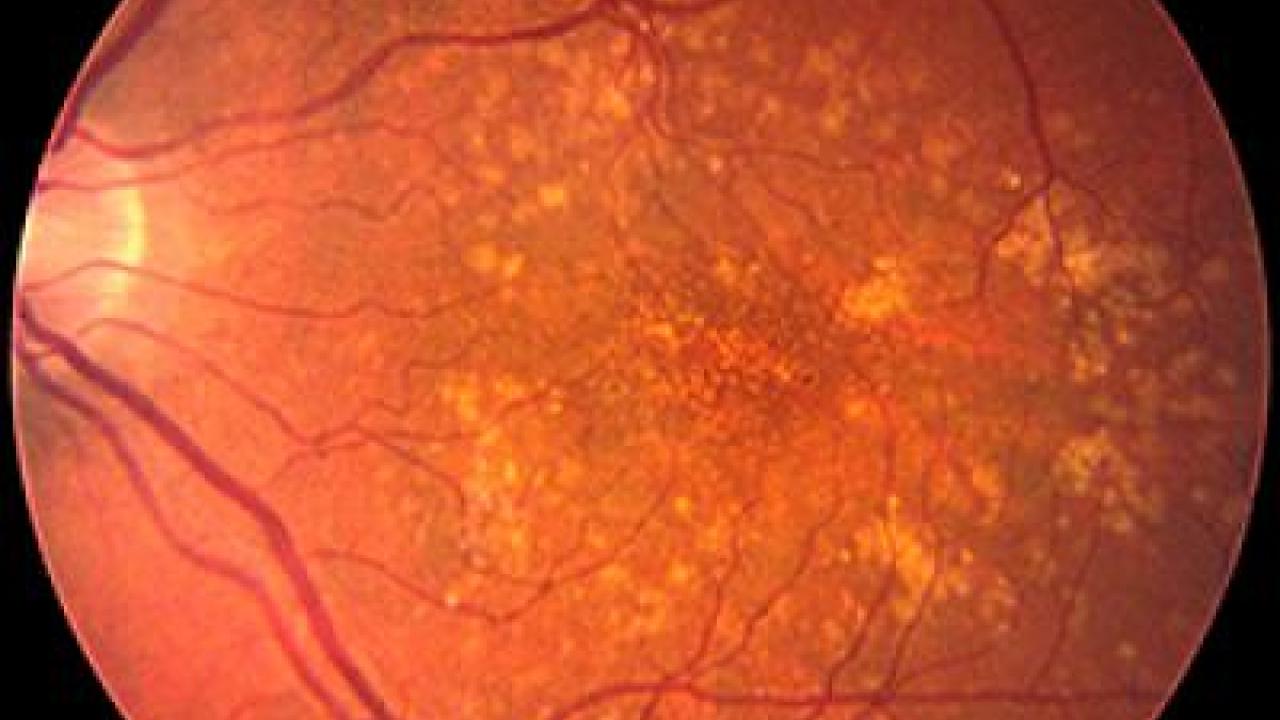 Retinal image showing signs of age-related macular degeneration (AMD).