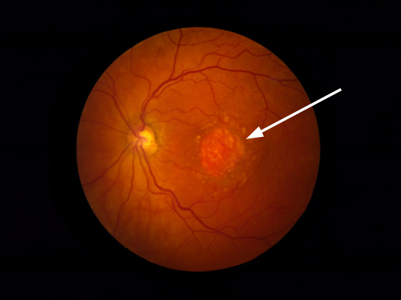 A microscopic image of an eye with geographic atrophy.