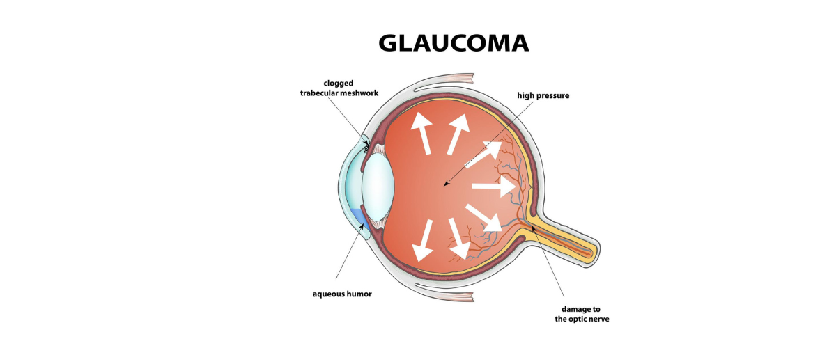 Illustration of eye with glaucoma.