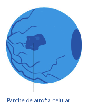 A medical illustration depicting geographic atrophy, a patch of atrophy in the macular region of the retina..