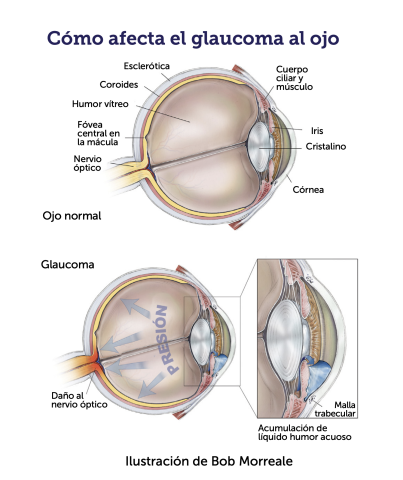 Diagram of how glaucoma affects the eye.