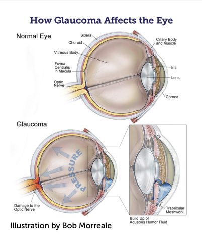 Diagram of how glaucoma affects the eye.