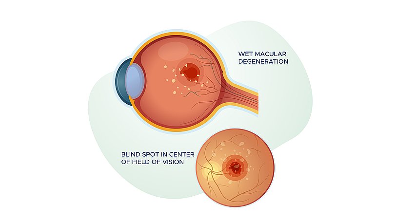 An image showing wet macular degeneration in the eye.