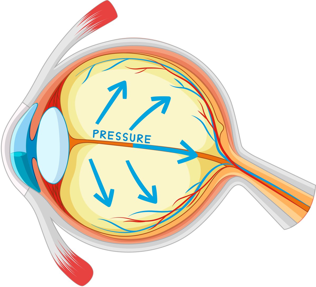 An illustration of eye pressure.