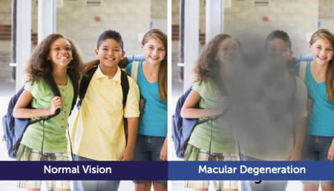 Normal vision vs. vision affected by macular degeneration.