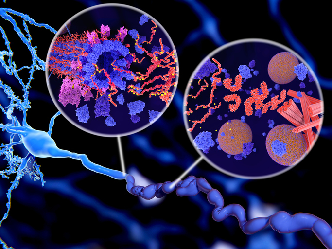 Pathological Tau protein (red-orange) phosphorylation (yellow) leads to disintegration of microtubuli and aggregation to neurofibrillary tangles (orange) in a neuron axon.