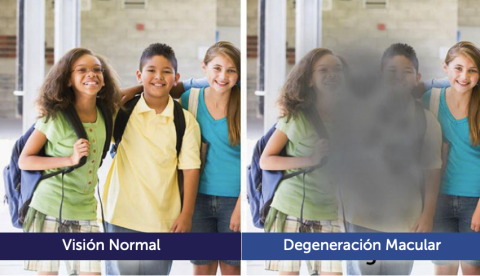 Normal vision vs. vision affected by macular degeneration.